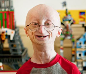 Progeria